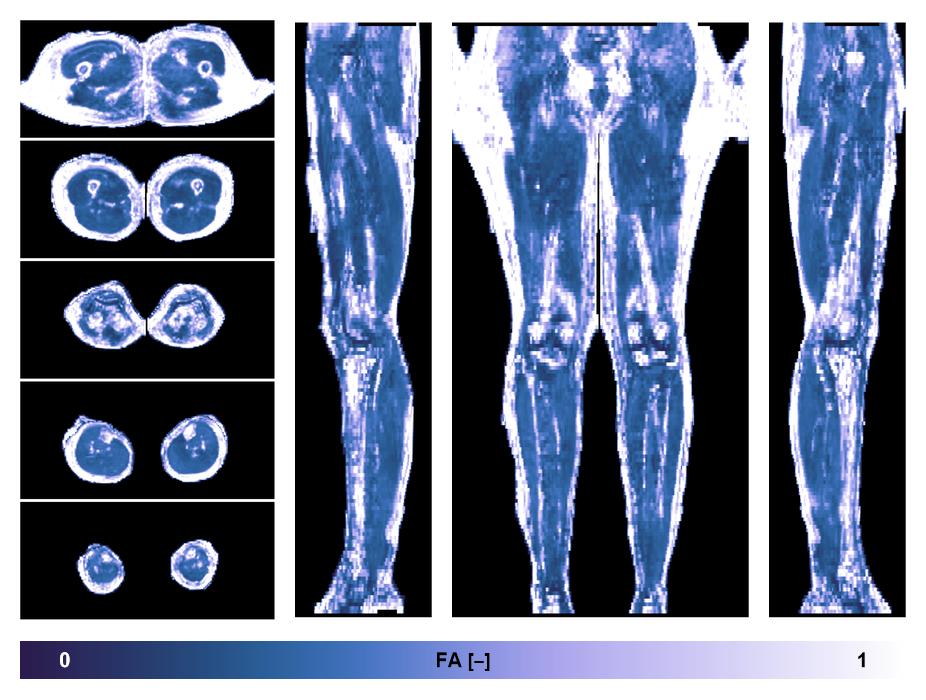 IVIM corrected whole leg muscle fractional anisotropy obtained from diffusion tensor imaging.